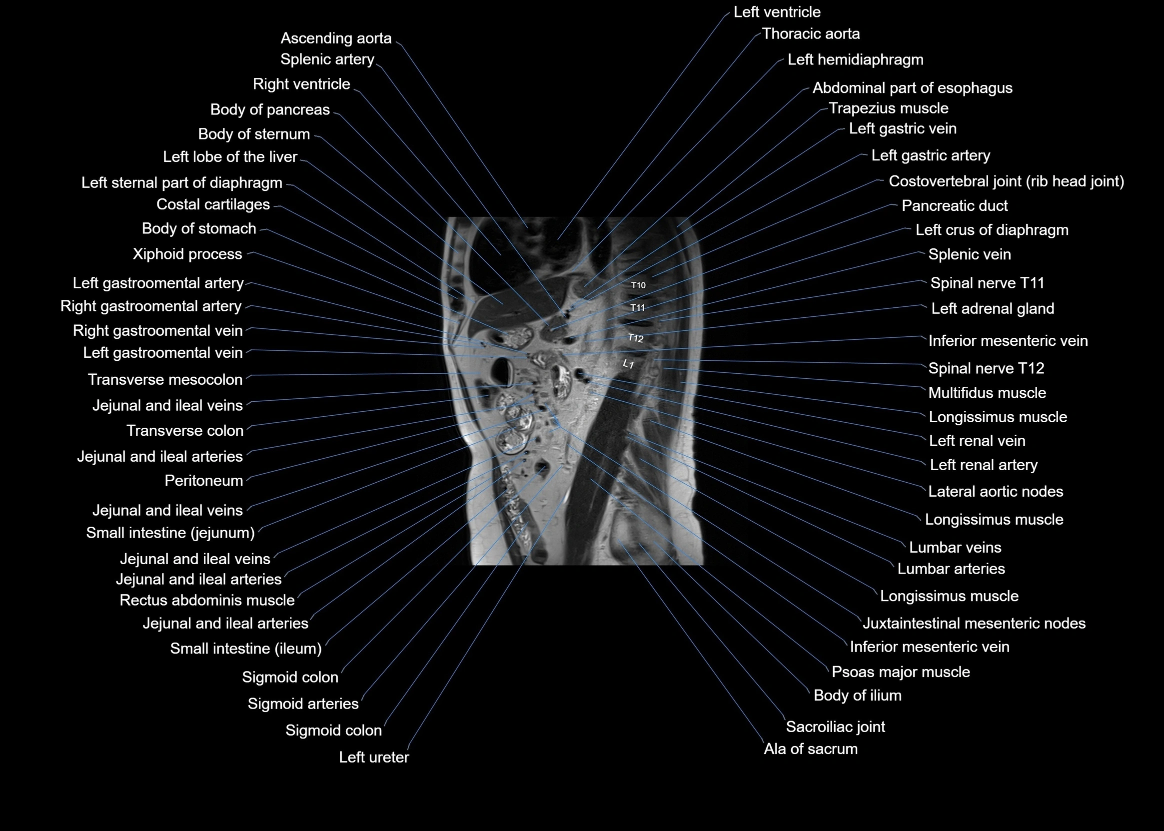 MRI abdomen sagittal cross sectional anatomy  radiology  image-img-00001-00042.webp
